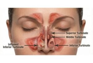 Turbinate Reduction in Kukatpally