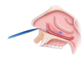 Turbinate Reduction _
