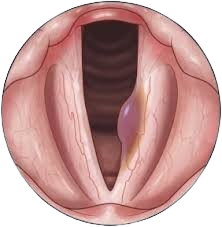 Vocal cord polyps surgery in Kukatpally