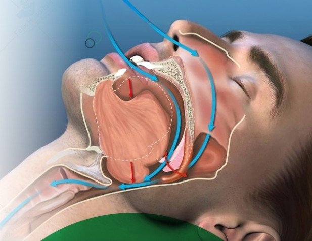 Surgery Cpap Sleep Apnea Surgery